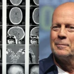 ¿Qué es la demencia frontotemporal, la enfermad que padece Bruce Willis?
